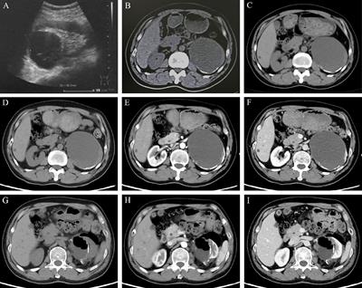 Primary renal mucinous adenocarcinoma masquerading as a giant renal cyst: a case report